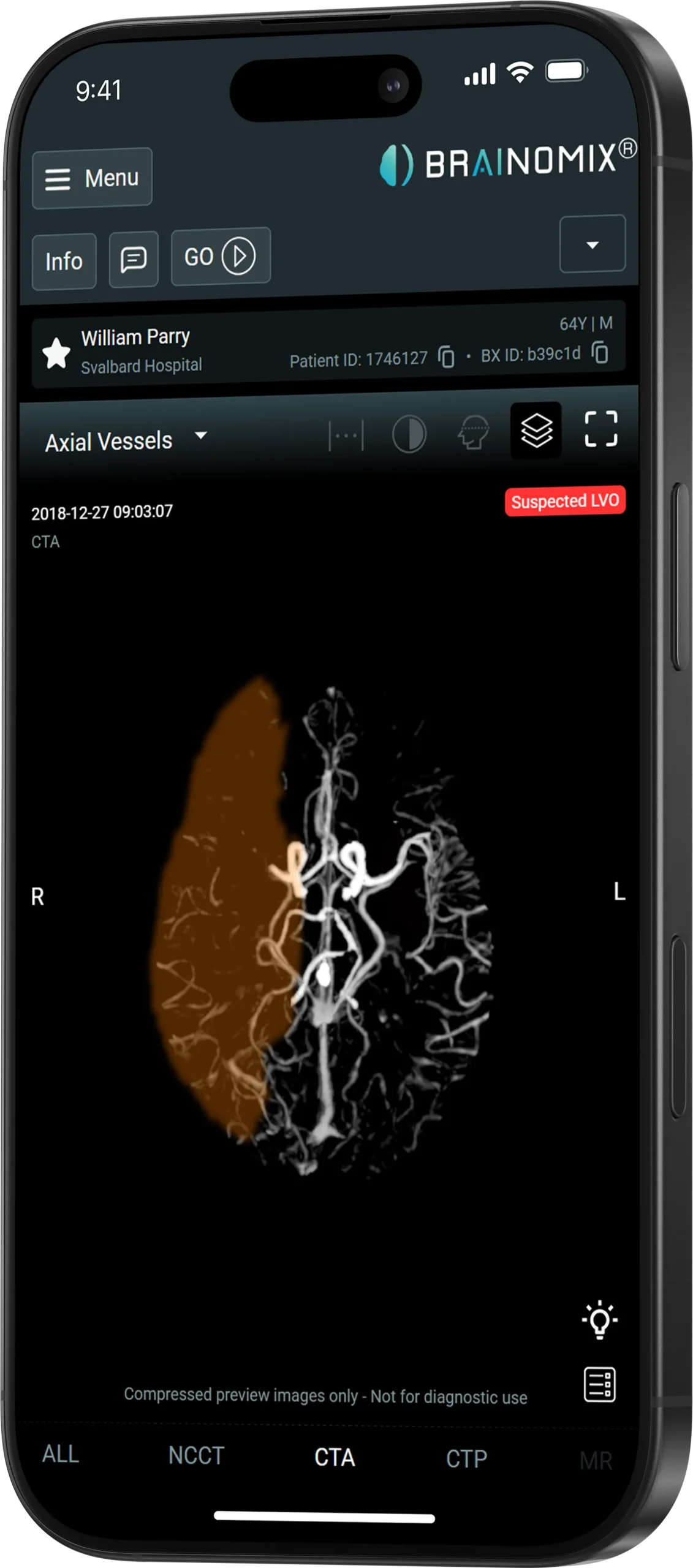 CTA large vessel occlusion detection