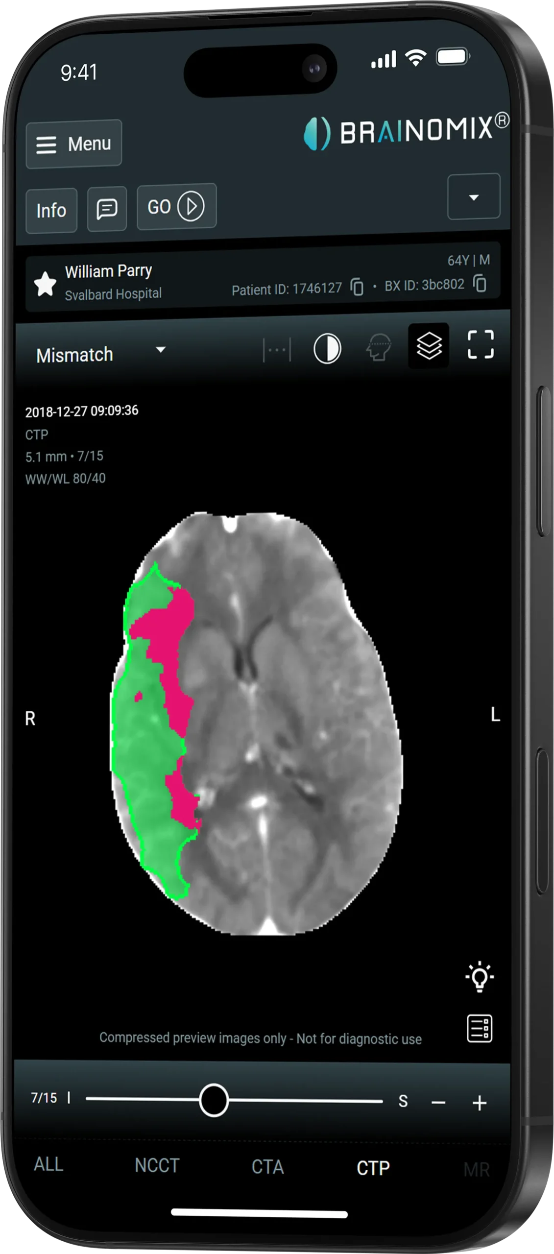 CT perfusion automated mismatch analysis
