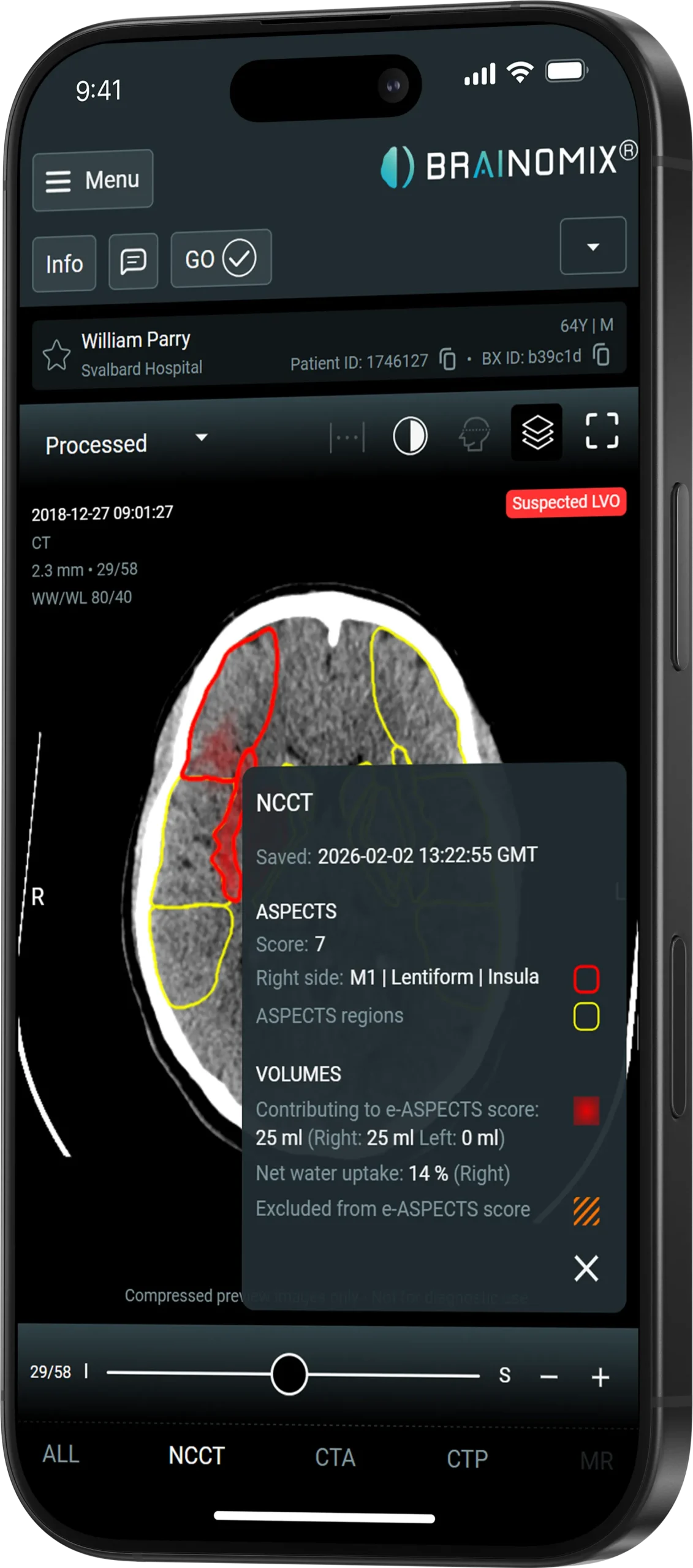 Brainomix NCCT suspected LVO and intracranial hemorrhage analysis